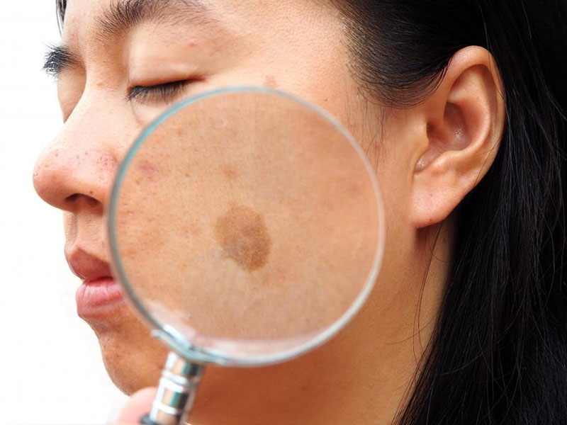 Láser de picosegundo: un buen ayudante para eliminar la melasma