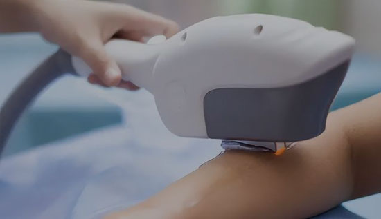 Máquina láser IPL